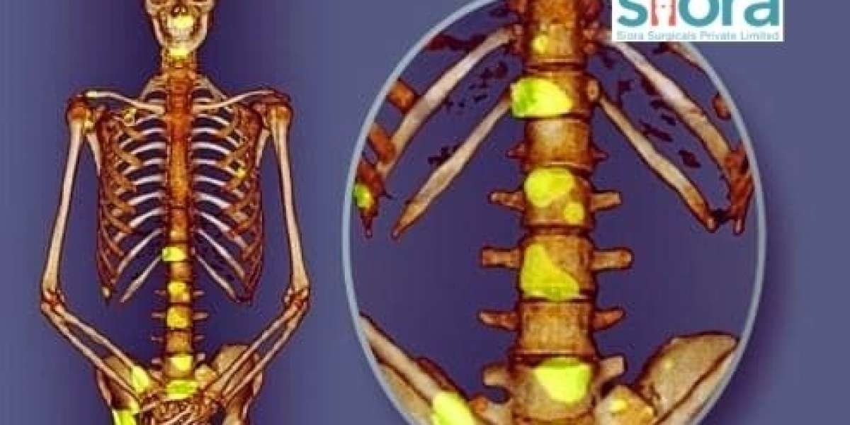 Bone Metastasis - What You Need to Know About