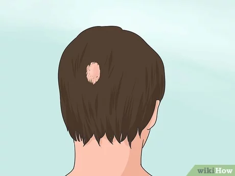 Hair loss in teenager