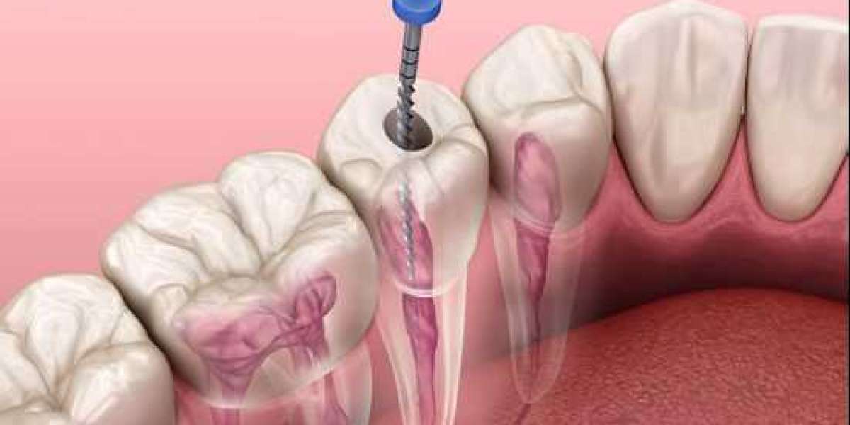 Why is Root canal treatment necessary?