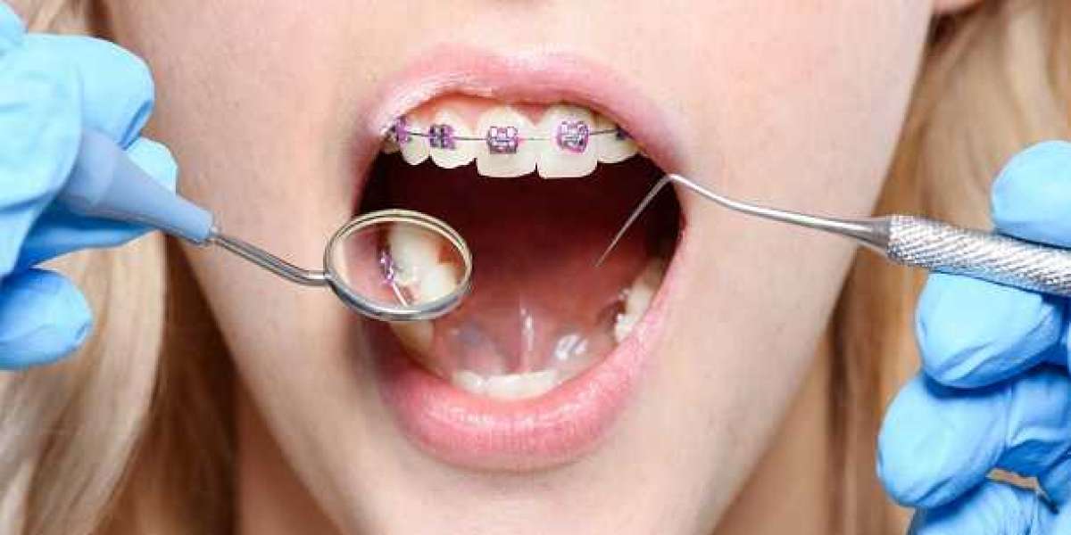 How To Prevent Cavities?