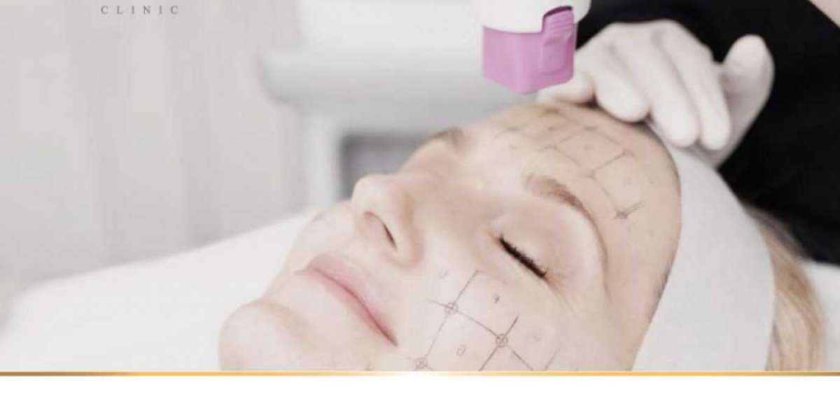 Thermage Skin Tightening Treatment London